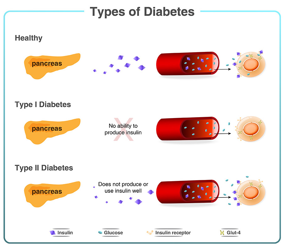 Types of Diabetes