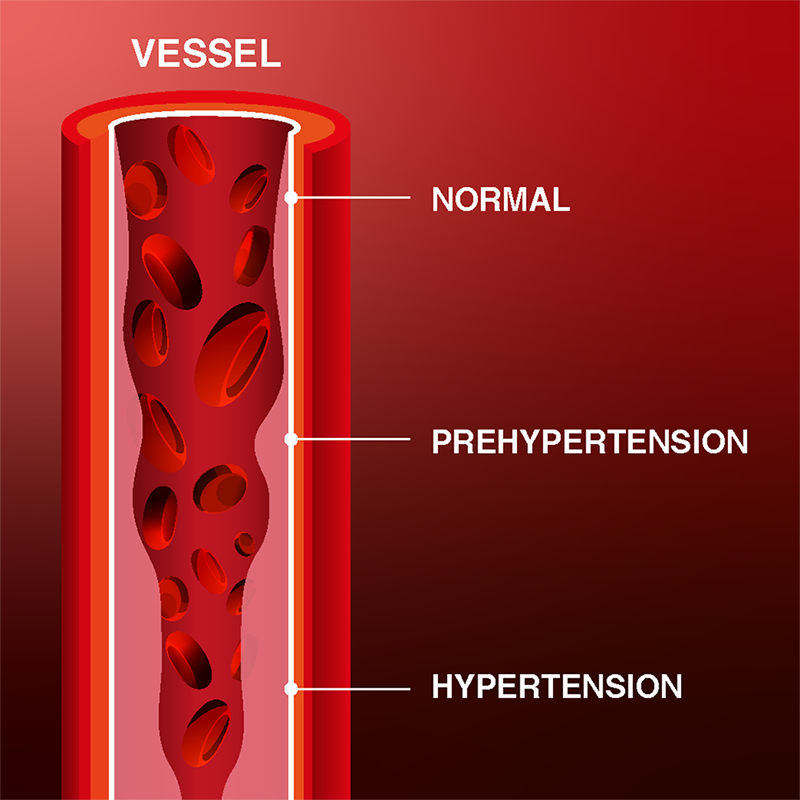 ForaCare Hypertension Solutions